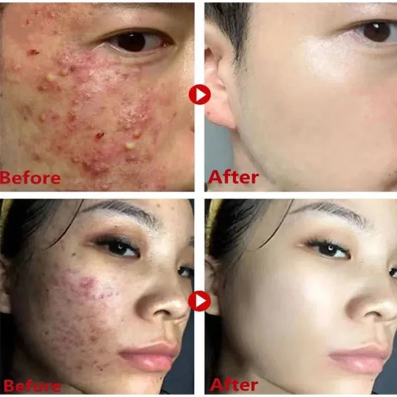 Remove Blackhead Mud Mask
